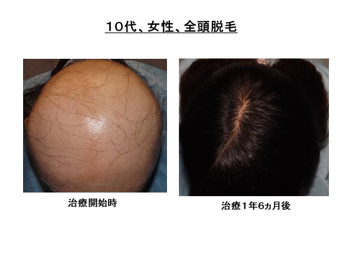 円形脱毛症　病院""